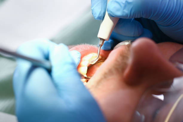 Best Emergency Dentist for Lost Fillings or Crowns in Farmersville, CA