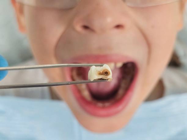 Best Emergency Dental Care for Abscessed Tooth in Farmersville, CA