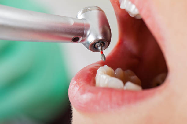 Best Emergency Dental Extractions in Farmersville, CA